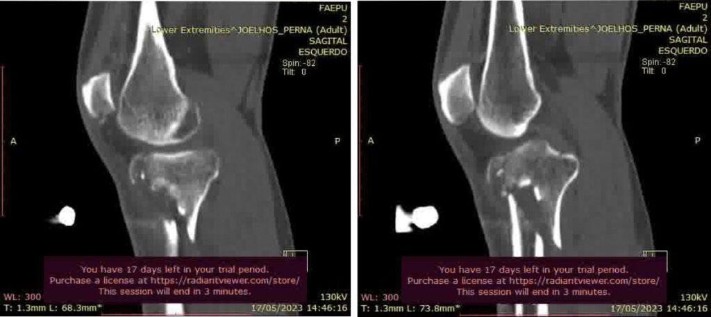 raio-x da fratura da perna de Frank Barroso